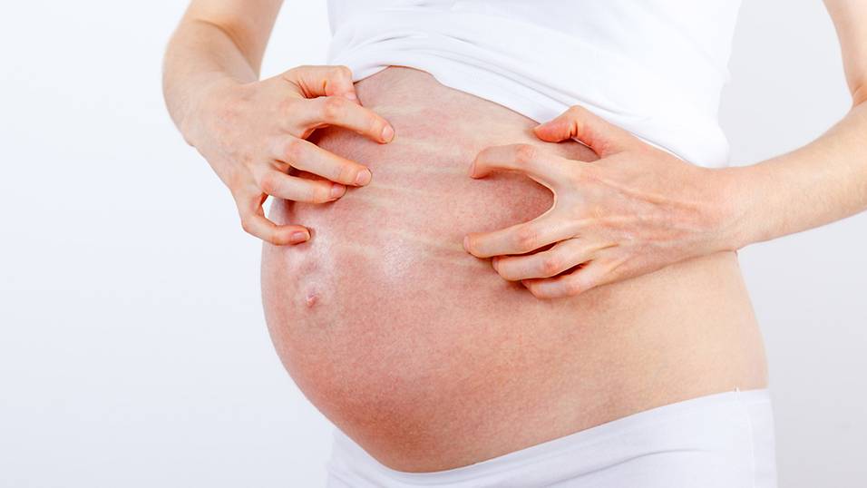 Pregnancy | Rash on Your Bump | You Could Have Puppp | SMG Women's Health