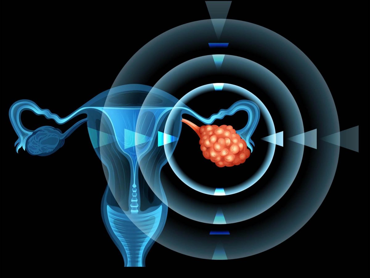 why-ovarian-cancer-is-so-hard-to-detect-smgwh