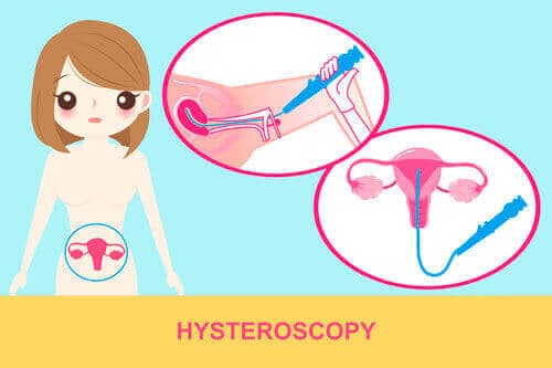 Hysteroscopic Surgery | Infertility Treatment SMG Women's Health