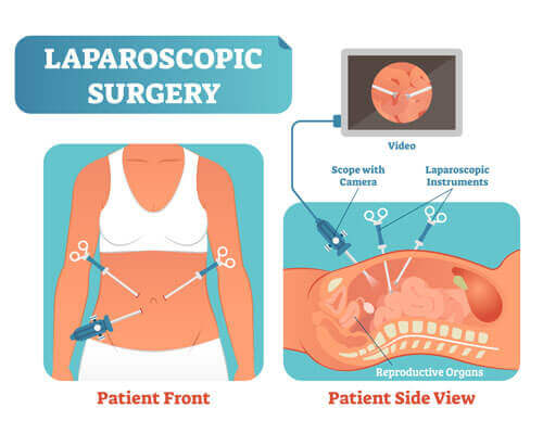 Laparoscopic Surgery (Keyhole) Infertility Treatment SMG Women's Health