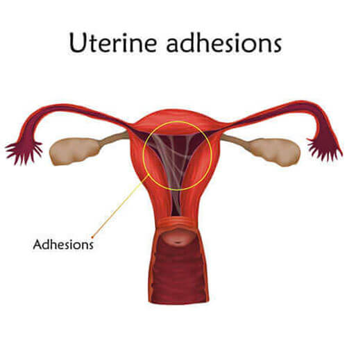 Uterine Adhesions | Infertility Treatment SMG Women's Health