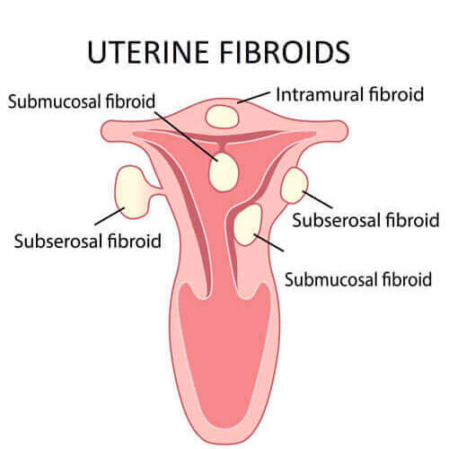 Uterine Fibroids | Infertility Treatment SMG Women's Health