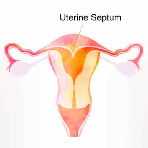 Uterine Septum | Infertility Treatment SMG Women's Health