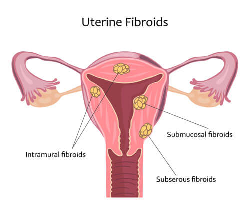 Position of Different Types of Uterine Fibroids SMG Women's Health