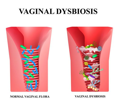 Vagina Dybiosis