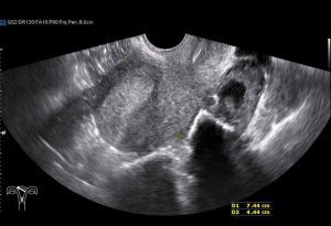 ultrasound of the uterus