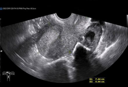 an ultrasound scan of the womb, showing endometriosis
